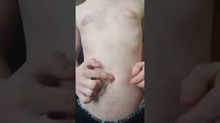 belly button outie
