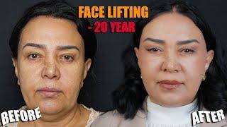 FACE LIFTING - ПОДТЯЖКА ЛИЦА - YUZ TORTTIRISH