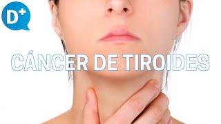 Cáncer de tiroides: Qué es, por qué se produce y cómo se trata