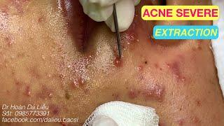 Nặn mụn nhọt ẩn vùng mặt chi chít|Squeeze big pimples, hidden acnes full face Dr Hoan 0985773391