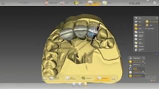 SPOILER: IT LOOKS GREAT... BUT Not The Easiest Anterior Design Using InLab 18