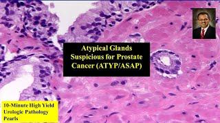 "Atypical glands suspicious for Prostate Adenocarcinoma (ATYP)" in Prostate biopsy