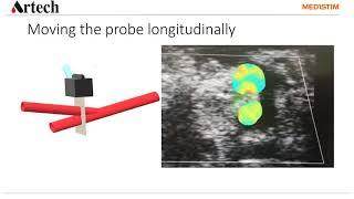 Basic on Coronary Echo Imaging with Medistim MiraQ™