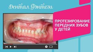  Протезирование передних зубов у детей