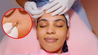 ASMR: Relaxing Hydra Facial Massage with ACNE Removal Treatment for Glowing Skin