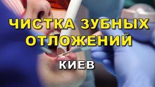 Профессиональная чистка зубов. Стоматология Люми-Дент, Киев