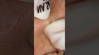 Skincare | Blackheads Removal #481 #tweezers skincare #blackheads blackheads