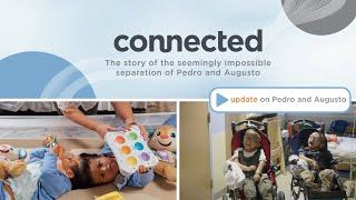 update on Pedro and Augusto, separated conjoined twins from connected documentary