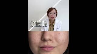 臉又油又乾？那你應該就是蟎蟲臉了！#shorts