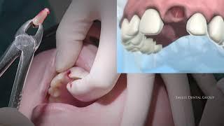 LIVE SURGERY DENTAL  EXTRACTION AND BONE GRAFT