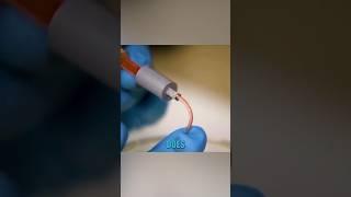 Gallium needle that doesn’t hurt