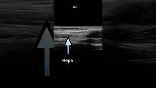 Опухоль нерва на УЗИ.
