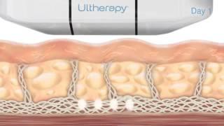 How Ultherapy Works