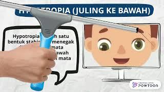 STRABISMUS ATAU MATA JULING