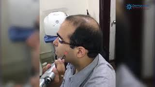 Dr Rohit Batra getting the machine tested on himself at Dermaworld Skin Clinics