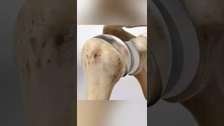 Total shoulder replacement (3D Animation)