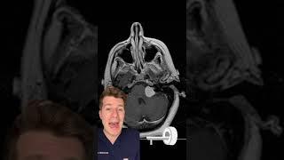 PART 1 - Unilateral hearing loss and tinnitus … what’s the diagnosis? #shorts #medical #health