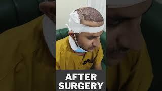 Hair transplant in bhopal | Amazing Hair transplant result #shorts #viral #hairtransplantinbhopal