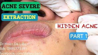 Nặn mụn ẩn mụn đầu đen đầy mặt|Squeeze hidden acne, acne severe full face dr Hoan 0985773391 part 1