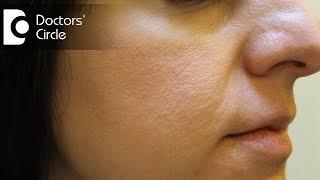 How to remove open pores of face permanently by homeopathic medicine? - Dr. Karagada Sandeep