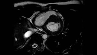 Hypertrophic Cardiomyopathy - Short-axis, ECG-gated cine SSFP MRI