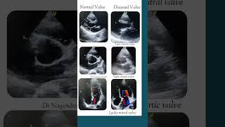 Normal v/s Diseased heart valve in echo( Tight & Leaky valve) #echo #shorts