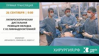 Лапароскопическая дистальная резекция желудка с D2 лимфаденэктомией.