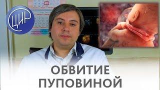 ОБВИТИЕ ПУПОВИНОЙ вокруг шеи. Бояться ли обвития пуповиной? Курганников А.С.