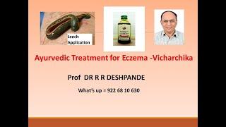 Ayurvedic Treatment For Eczema  l Vicharchika   l Ayurveda l Eczema causes l Eczema Medicines