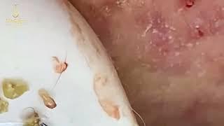 Loan Nguyen Acne Treatment 1600mh