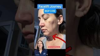 This Is A Facelift Journey (BEFORE AFTER RESULTS)