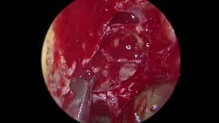 Full Functional Endoscopic Sinus Surgery (FESS) for sinusitis