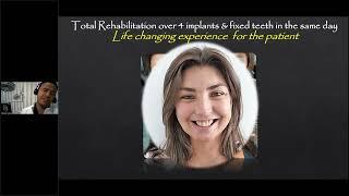 BEGO Implant Systems – Webinar – Implant surgery and fixed teeth in the same day (język angielski)