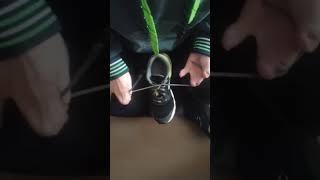 A guy with Apert Syndrome ties his own shoe.