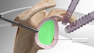 Восстановление суставной губы лопатки
