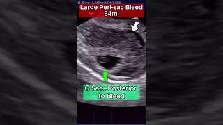Ultrasound High Risk 6wks Pregnancy - with Heavy Bleed
