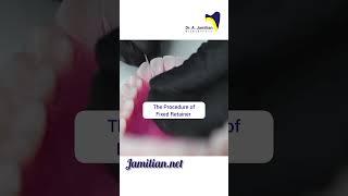 Procedure of Fixed Retainer #dentist #bracing #fixedretainer#Retainer#Orthodontics#Retention
