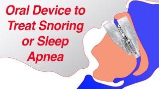 Mandibular Advancement Device (MAD) to Treat Snoring and Sleep Apnea