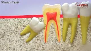 All you need to know about the eruption of a wisdom tooth