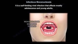 Infectious Mononucleosus - Everything You Need To Know - Dr. Nabil Ebraheim