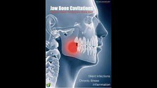 Cavitations : the unknown problem