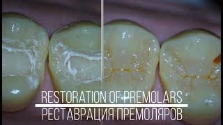 Restoration of maxillary premolars