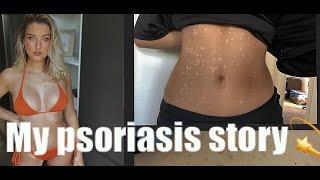 MY JOURNEY WITH PSORIASIS  •Millie Jane