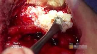 ELEVACIÓN BILATERAL SENO MAXILAR INSTALACIÓN DE 6 IMPLANTES TSV PARA PROTESIS HIBRIDA