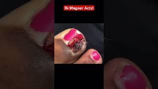 EXTRACTION OF EXTREMELY INFECTED INGROWN TOENAIL#shorts