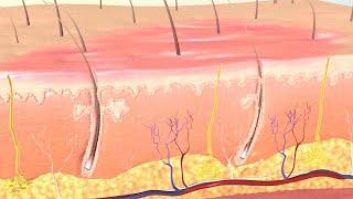 How Burns are Classified and Treated