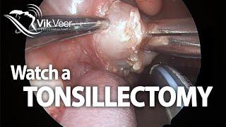 Watch a Tonsillectomy Operation