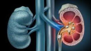 What causes KIDNEY STONE?how to tackle it?