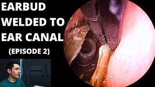 Ear Bud Welded To Ear Canal! (Episode 2)