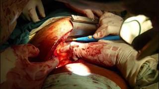 Graft replacement of descending aorta with left lower pulmonary lobectomy